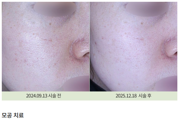 모공치료 관련 이미지