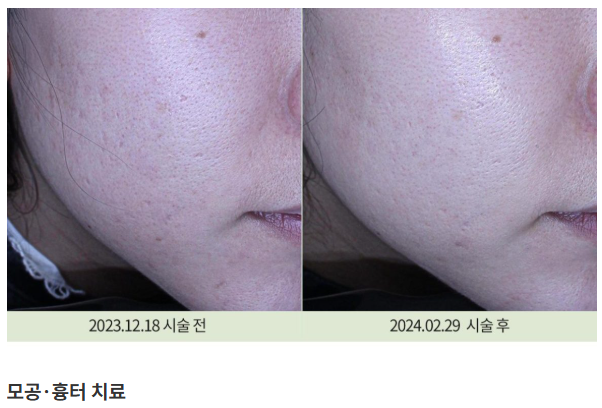 모공·흉터 관련 치료 사진