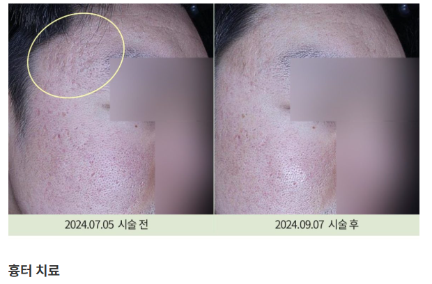 여드름흉터치료 관련 이미지